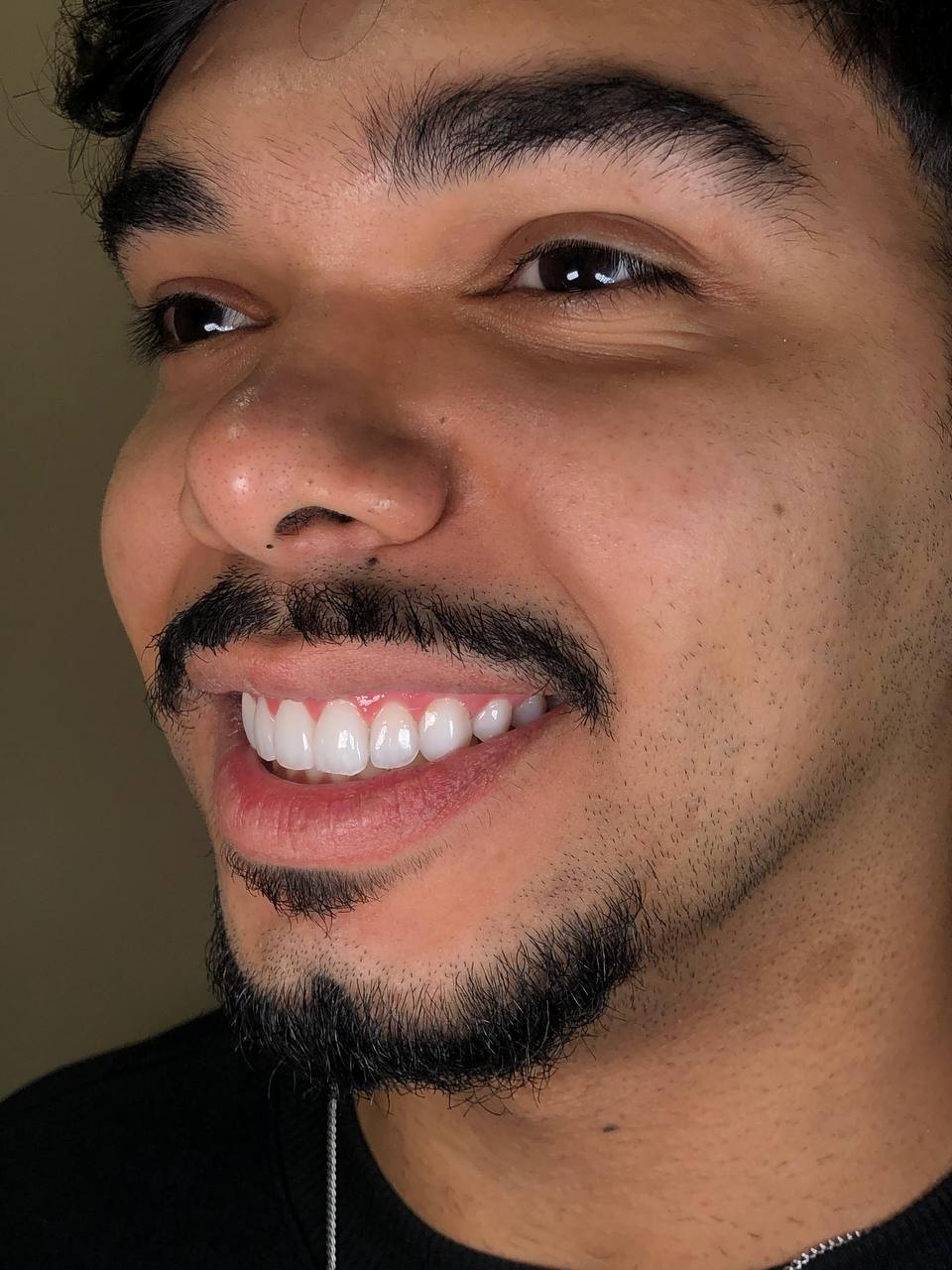 Fotografia do sorriso e do rosto do paciente no Caso 03