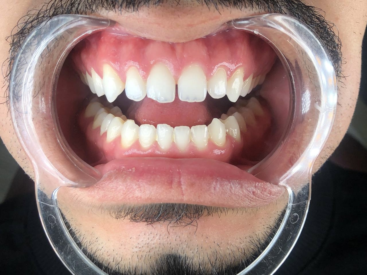 Fotografia clínica do paciente com afastador no Caso 03