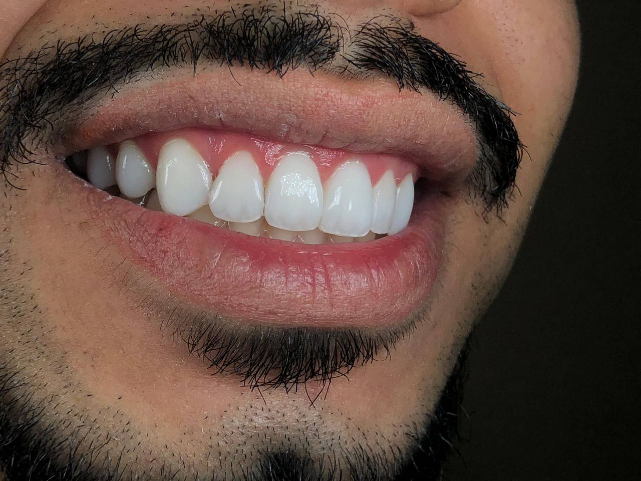 Fotografia aproximada do sorriso do paciente no Caso 03