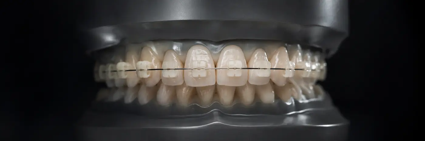Imagem demonstrativa de aparelho ortodôntico de porcelana em modelo odontológico