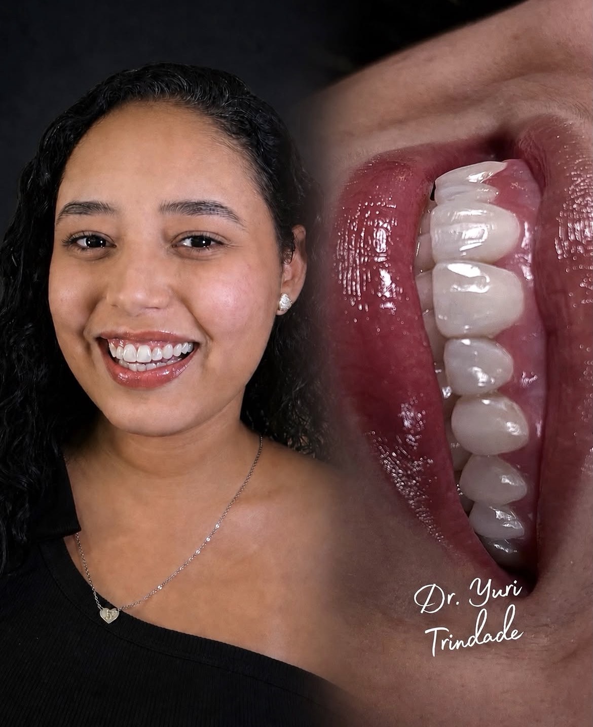 Resultado real de tratamento odontológico em paciente sorrindo
