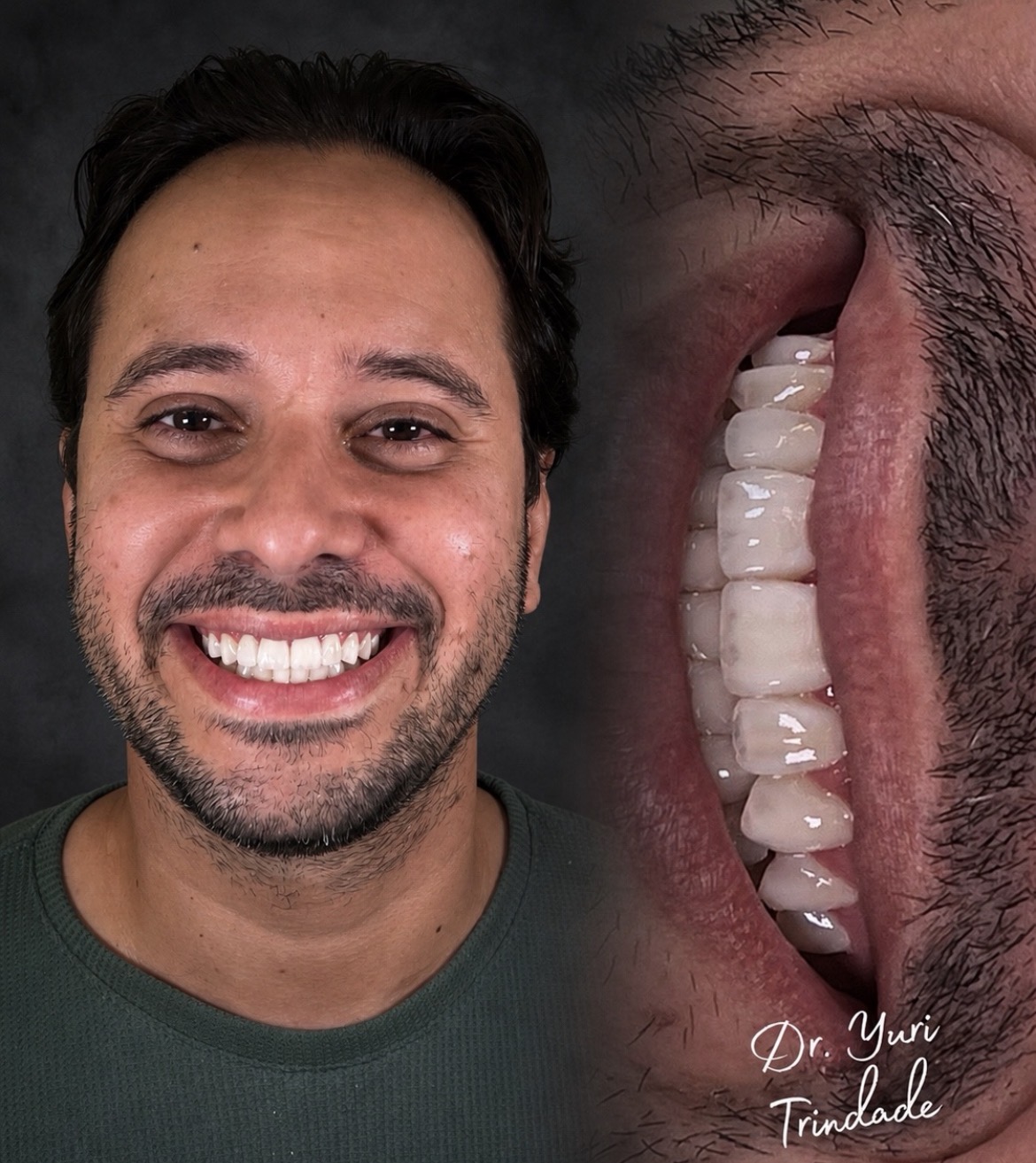 Resultado real de tratamento odontológico em paciente sorrindo